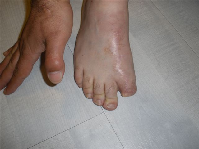 greffe orteil amputation