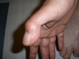 greffe du pouce orteil