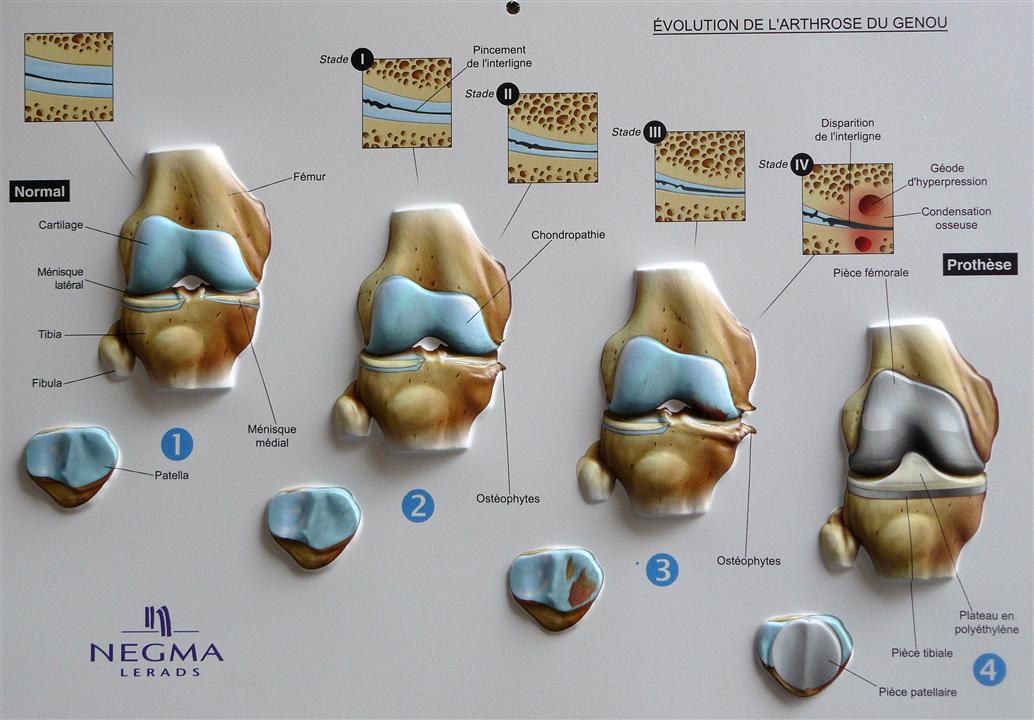evolution de l'arthrose du genou