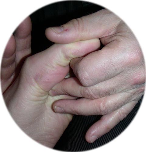 ostéopathie de l'hallux valgus