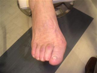 pathologie hallux valgus avant pied