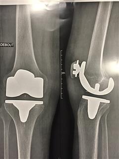 radio genou prothèse