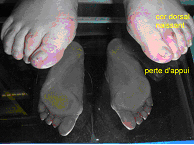 déformation hallux valgus
