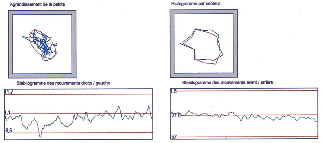bilan stabilométrique histogramme stabilogramme