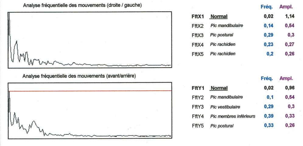 calcul fréquentiel stabilogramme bilan stabilométrique