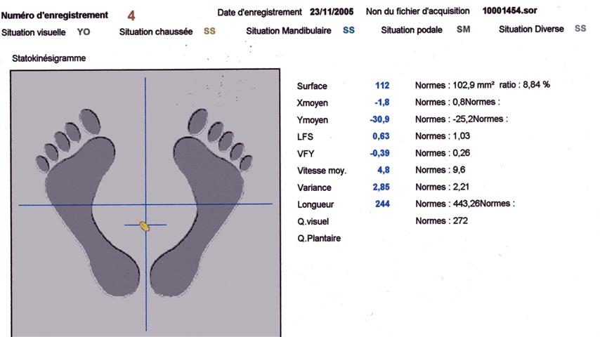 stabilométrie norme résultat stabilogramme